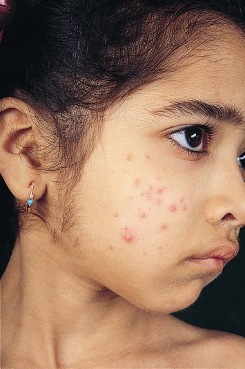 Acne