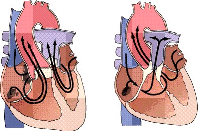 Transposición completa de las grandes arterias