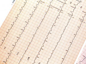 ¿Qué es la Angina de Pecho?